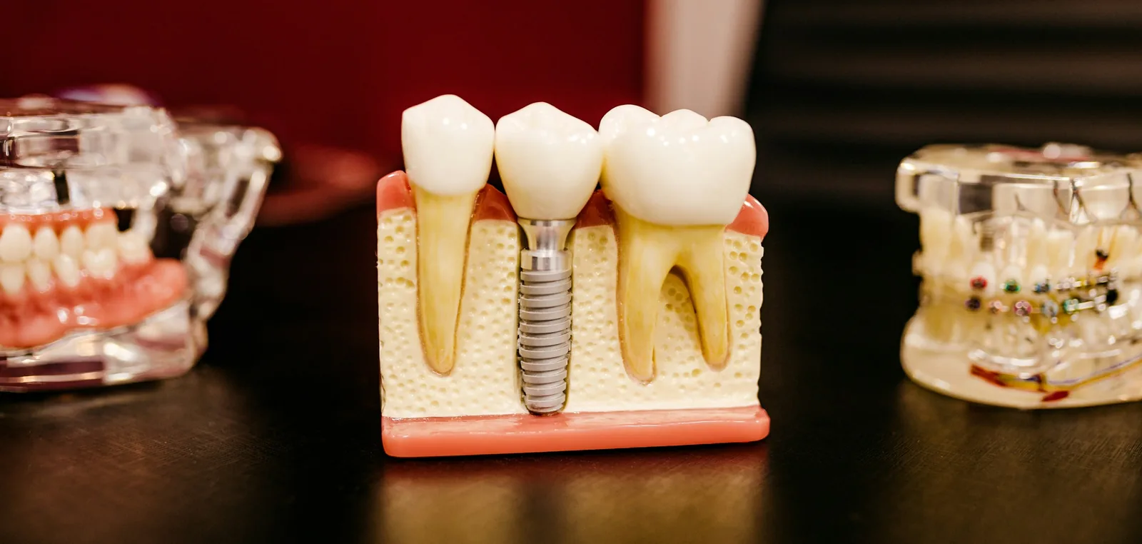 Implantes dentários — Sorridents Novo Horizonte