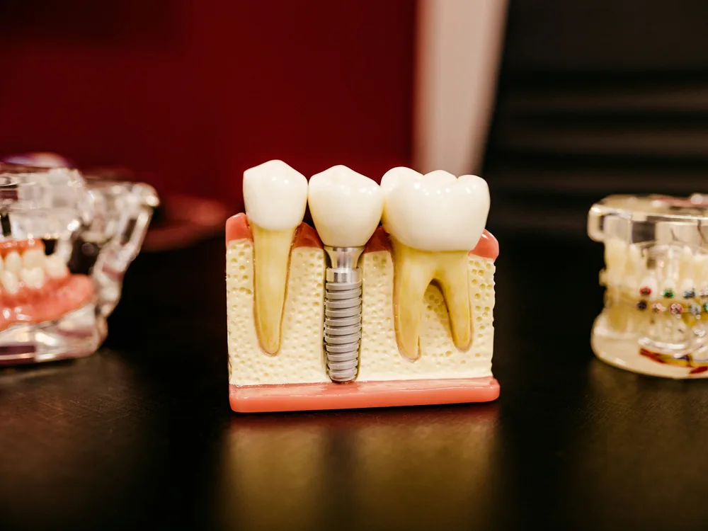 Modelo de implante dentário com coroa entre dentes naturais